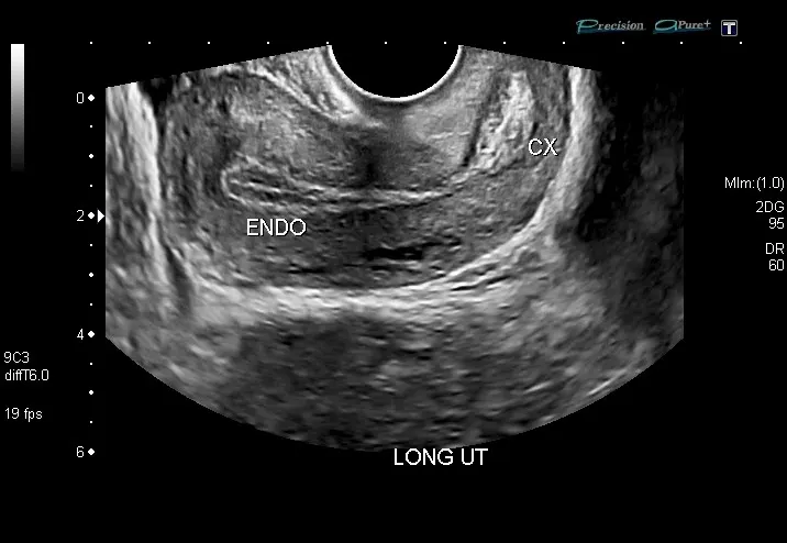 A greyscale scan of the womb on a Toshiba screen at the centre